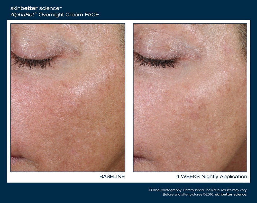 Intensive AlphaRet Overnight Cream