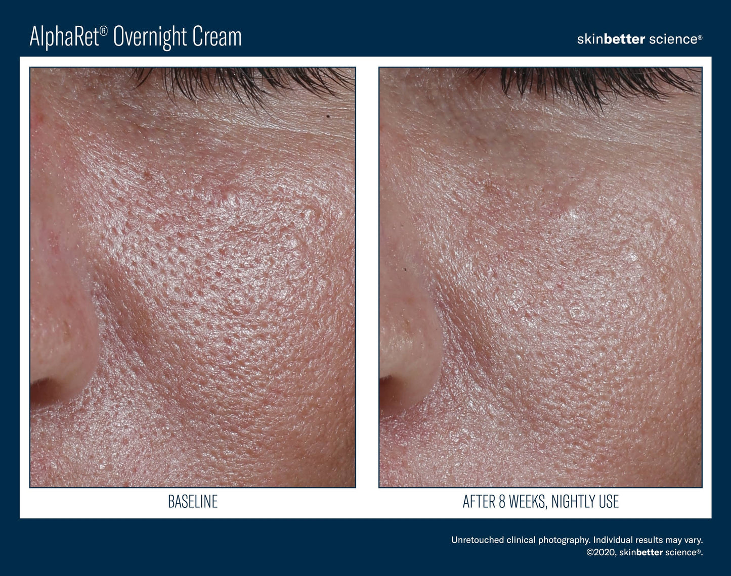 Intensive AlphaRet Overnight Cream