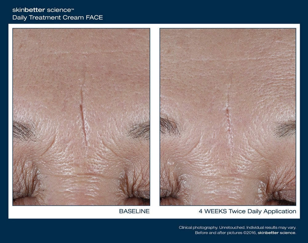 InterFuse Face and Neck
