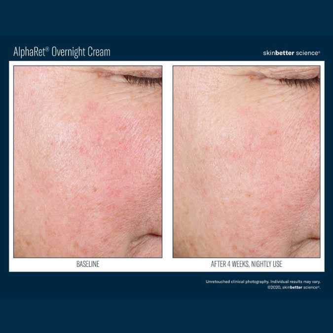 Intensive AlphaRet Overnight Cream