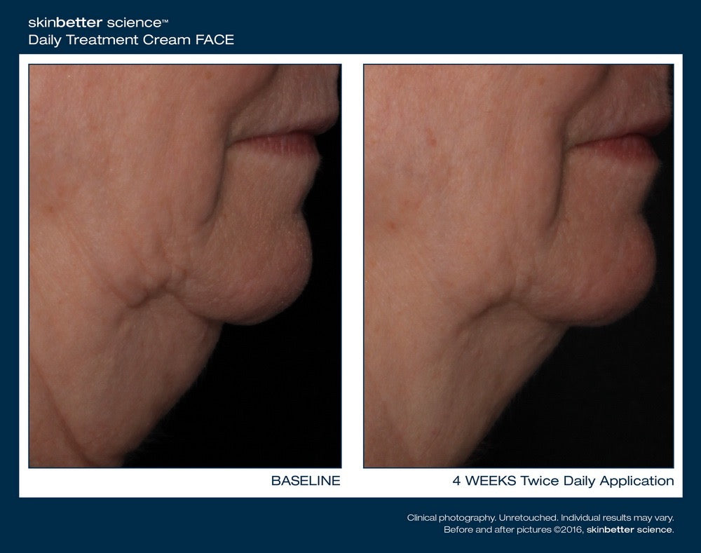 InterFuse Face and Neck
