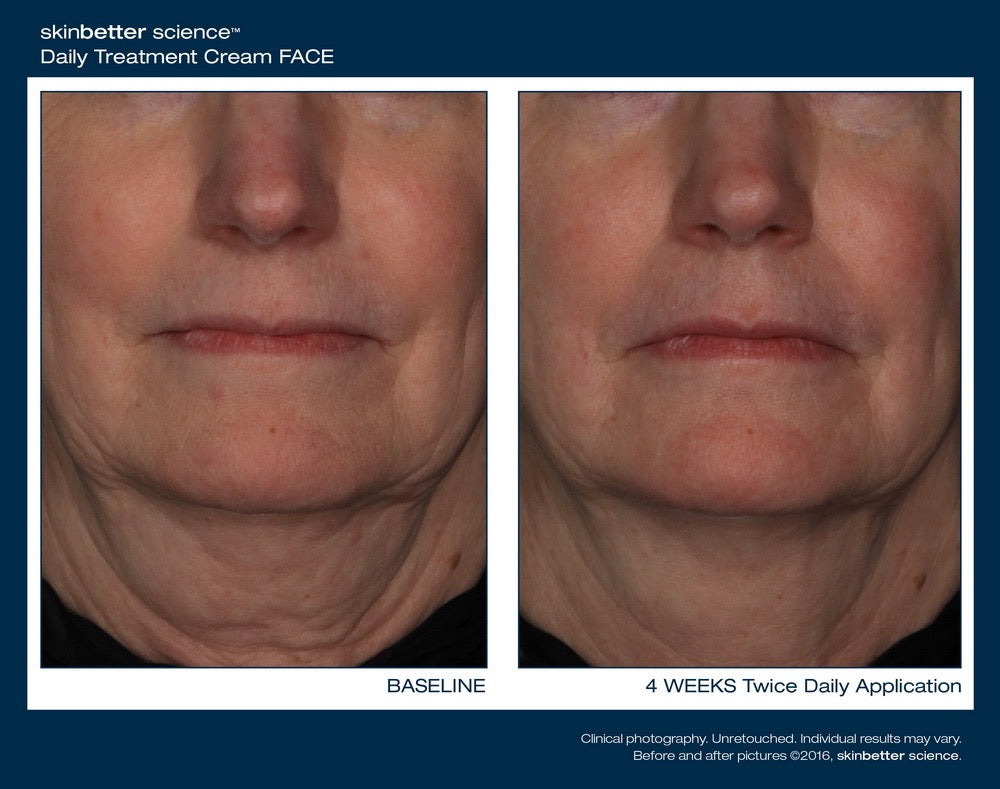 InterFuse Face and Neck