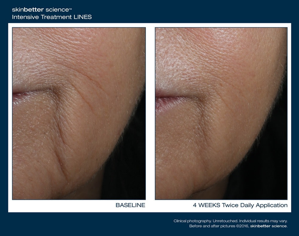 InterFuse Intensive Treatment LINES