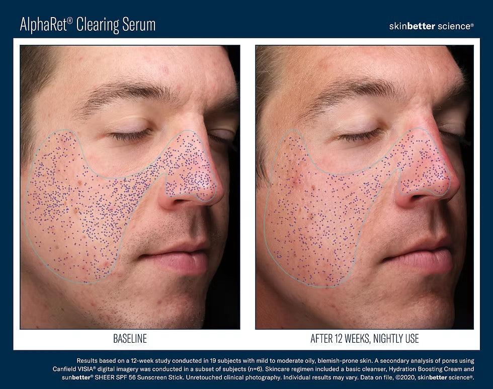 AlphaRet Clearing Serum