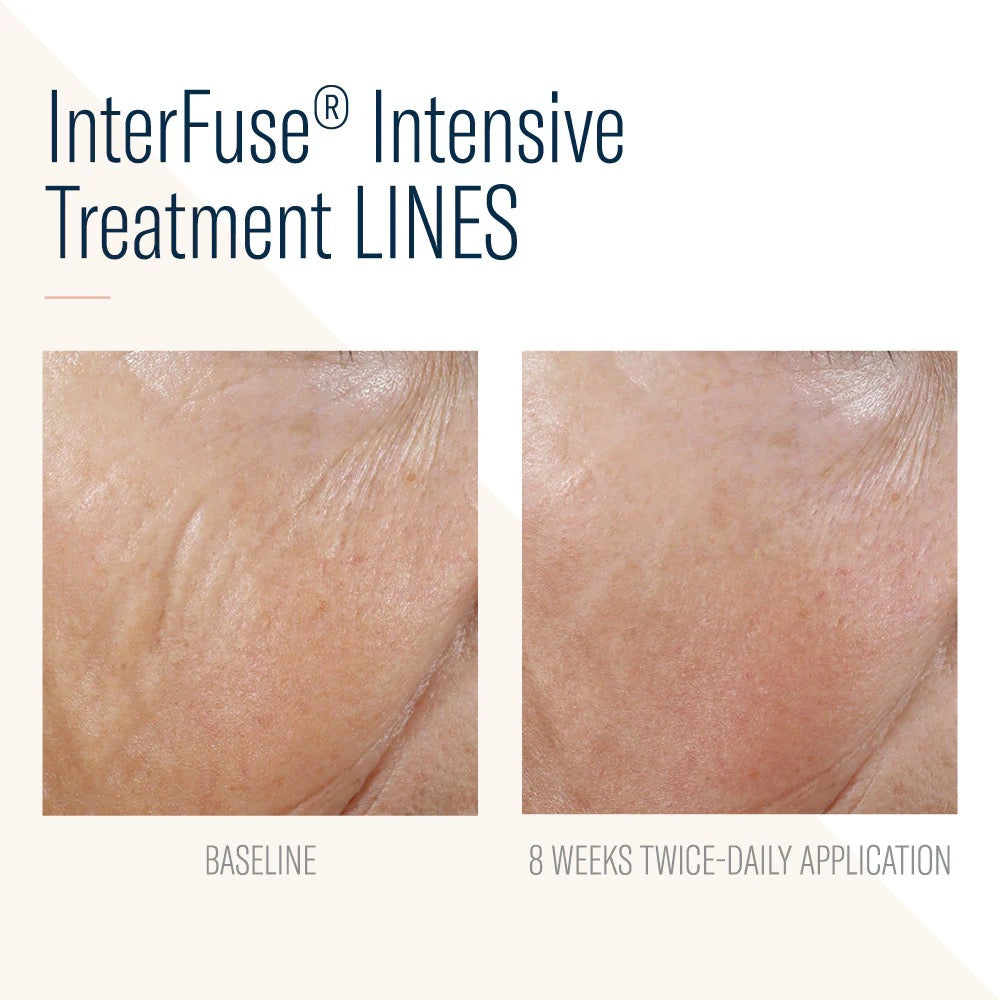 InterFuse Intensive Treatment LINES