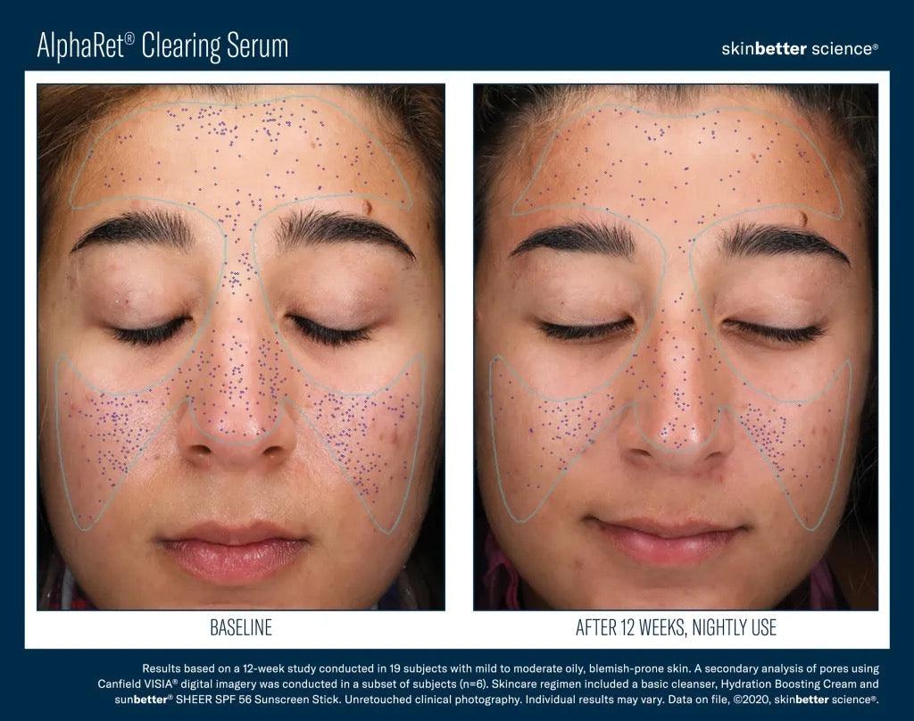 AlphaRet Clearing Serum