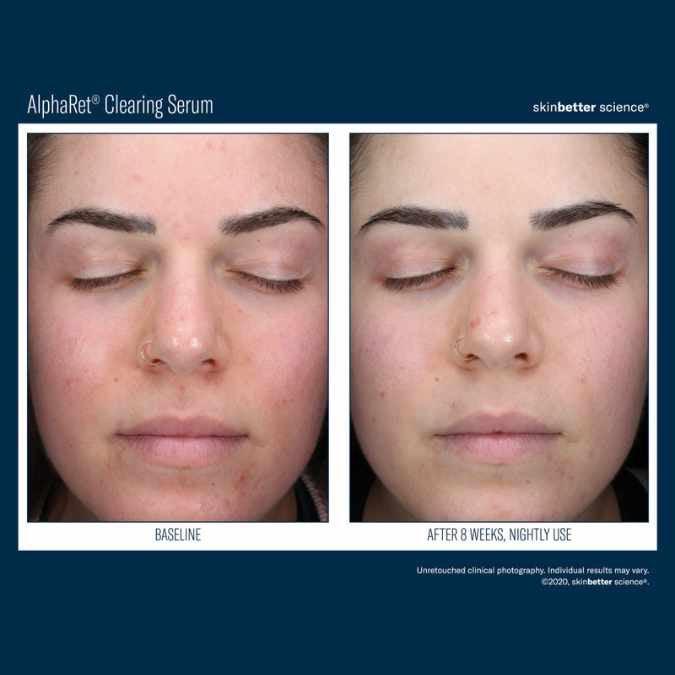 AlphaRet Clearing Serum