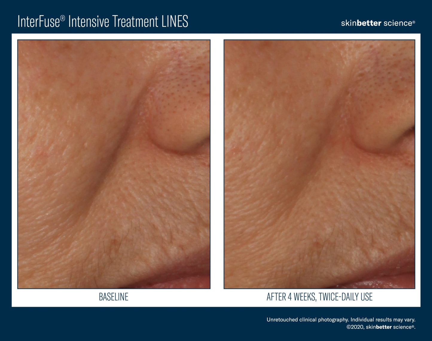 InterFuse Intensive Treatment LINES
