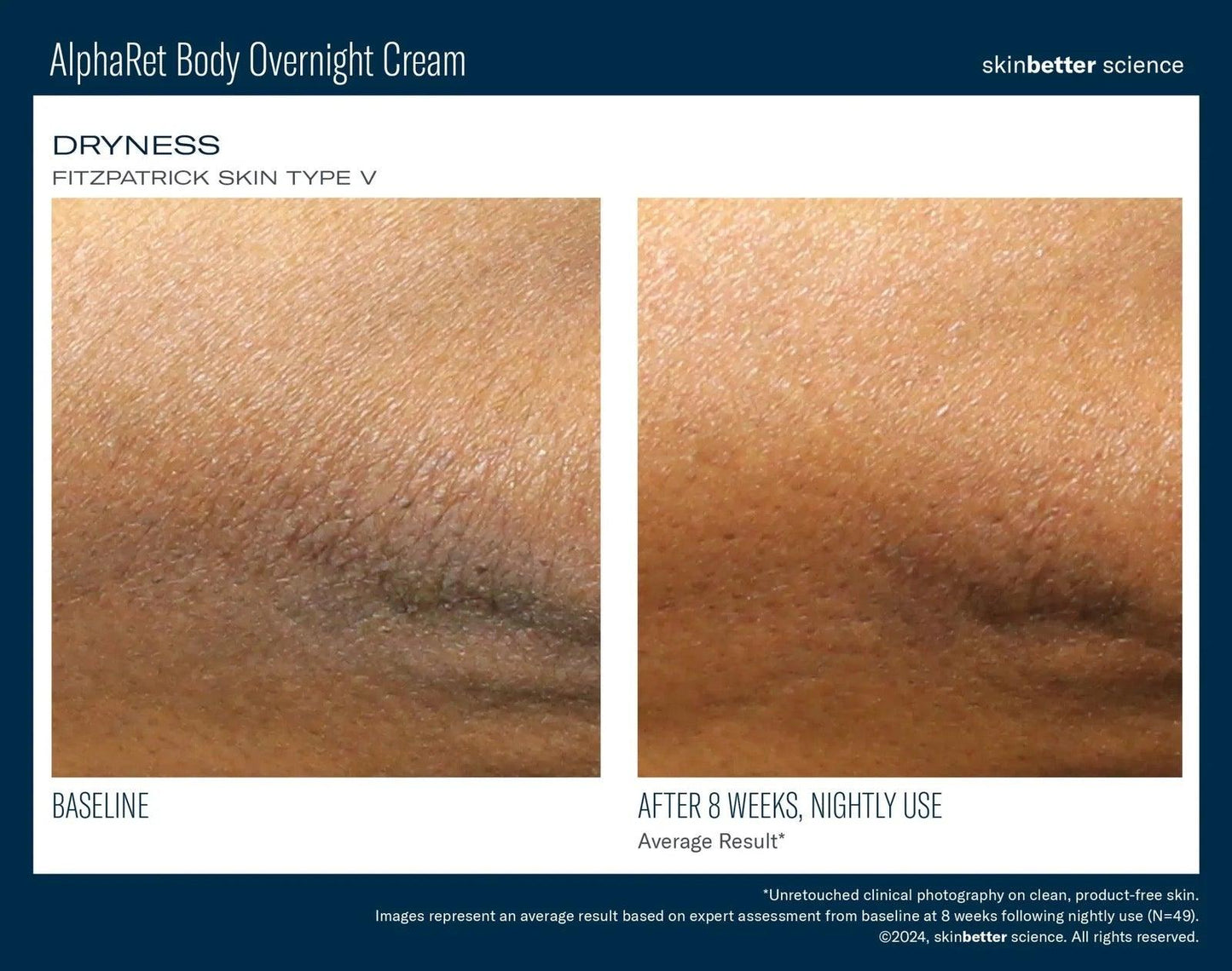 AlphaRet Body Overnight Cream