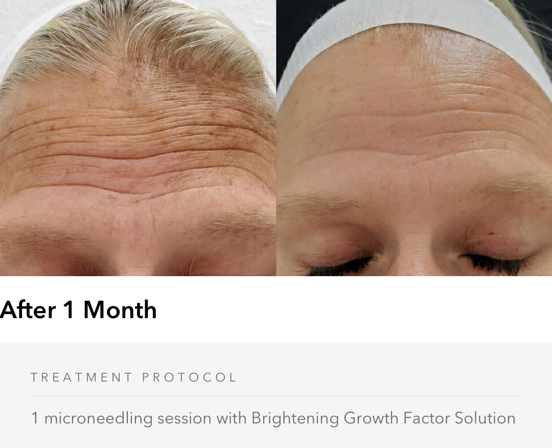 Brightening After Care Kit MD