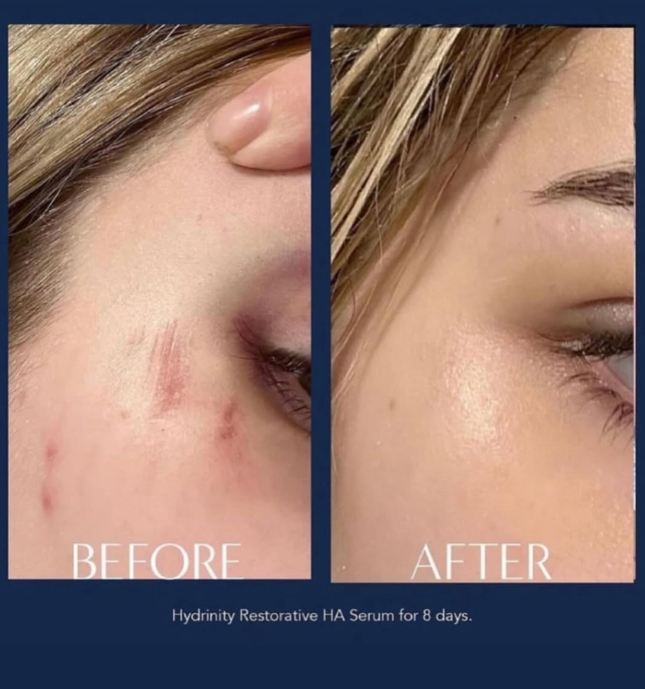 Restorative HA Serum with PPM6 Technology