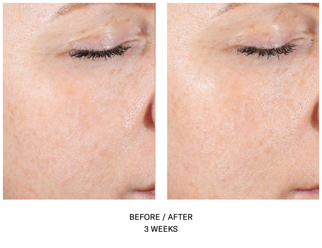 AlphaRet Exfoliating Peel Pads